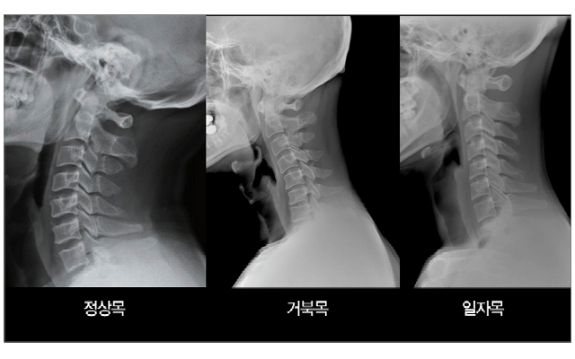 병점일자목, 거북목 교정 목만 교정하면 될까요?